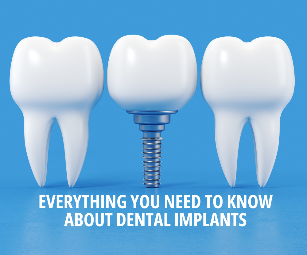 Everything You Need To Know About Dental Implants